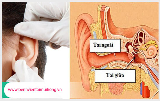 Khái niệm bệnh viêm tai ngoài