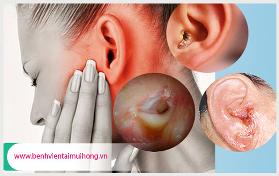 Tìm hiểu khái niệm bệnh viêm tai xương chũm