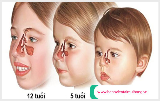 Viêm xoang mũi ở trẻ em: cách phòng tránh