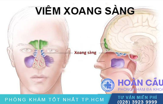 viem-xoang-sang-3(1).png