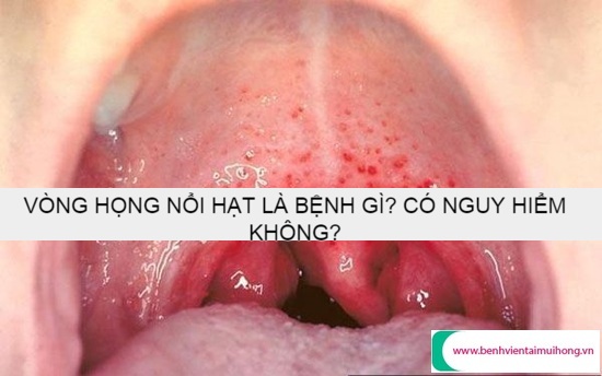 [TPHCM] Vòm họng nổi hạt là bệnh gì? Bệnh có nguy hiểm không?